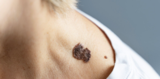 Câncer de pele e desinformação: por que buscar orientações seguras é essencial no diagnóstico precoce da doença cancer pele