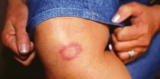 Hanseníase: conheça verdades e mitos sobre a doença hanseniase