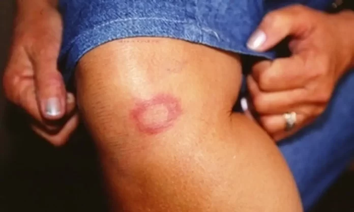 1334792203 hanseniase