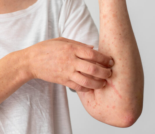 Tipos de alergia mais comuns: Saiba quais são e como tratá-las tipos de alergia