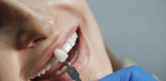 Conheça as diferenças entre facetas e lentes de contato bucais