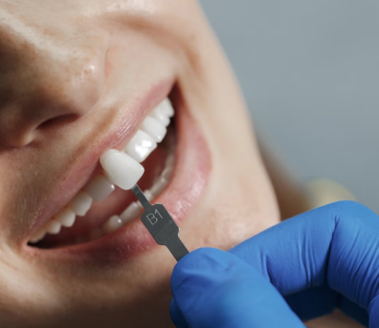 Conheça as diferenças entre facetas e lentes de contato bucais