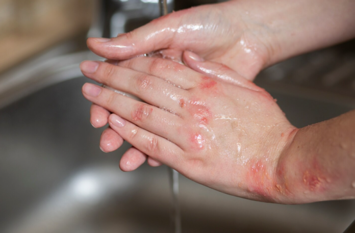 https://www.magnific.com/free-photo/hands-patient-suffering-from-psoriasis_23991872.htm#fromView=search&page=1&position=2&uuid=10a09f15-58c2-488b-8cfb-450af6cf69ca&query=queimadura o que fazer queimadura